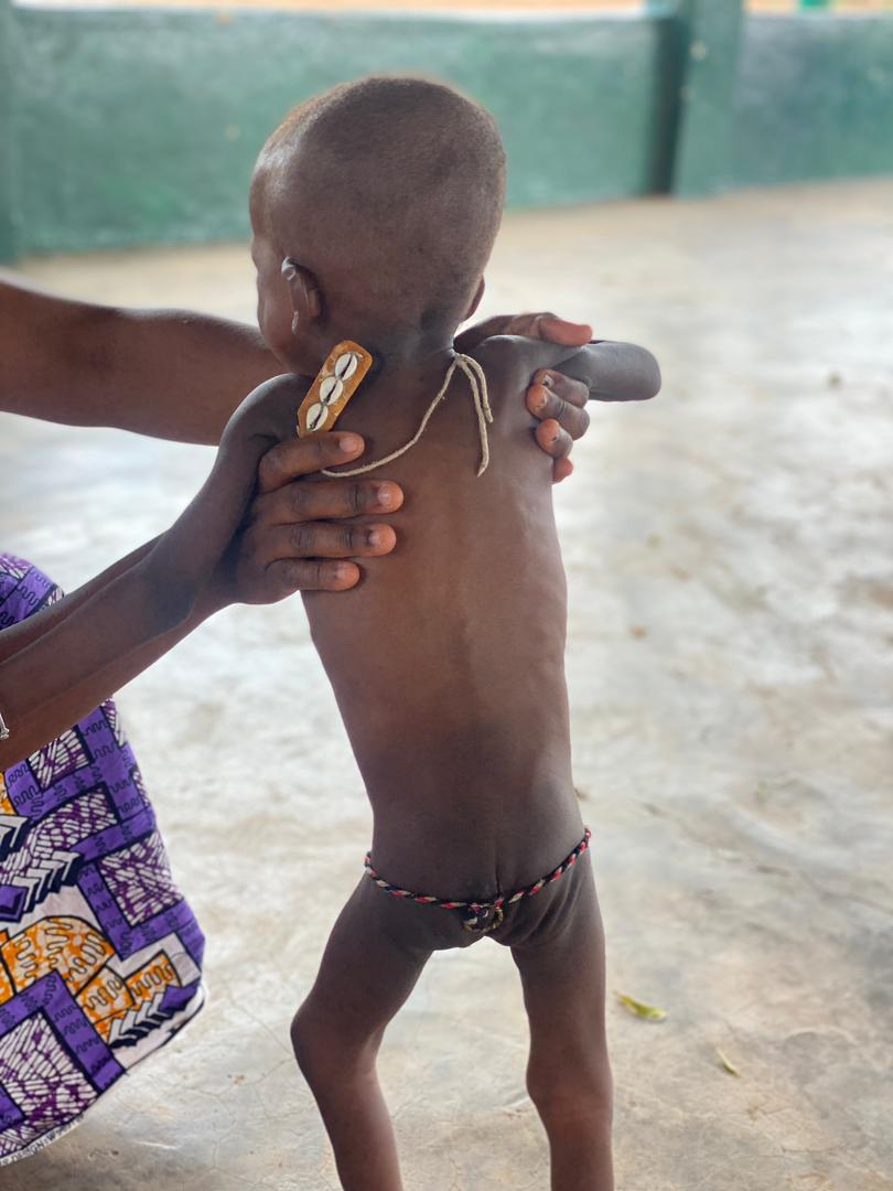 Bawku conflict leads to malnutrition surge among children - Channel1 News